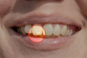 Le macchiette bianche sui denti sono un danneggiamento dello smalto