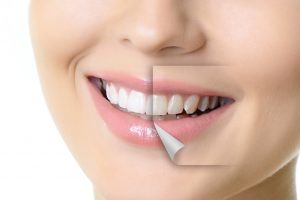 I trattamenti per avere sempre denti bianchi