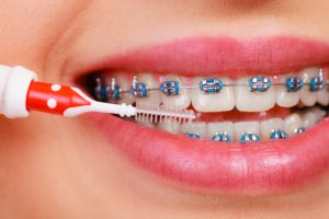 Come curare l'igiene orale con l'apparecchio