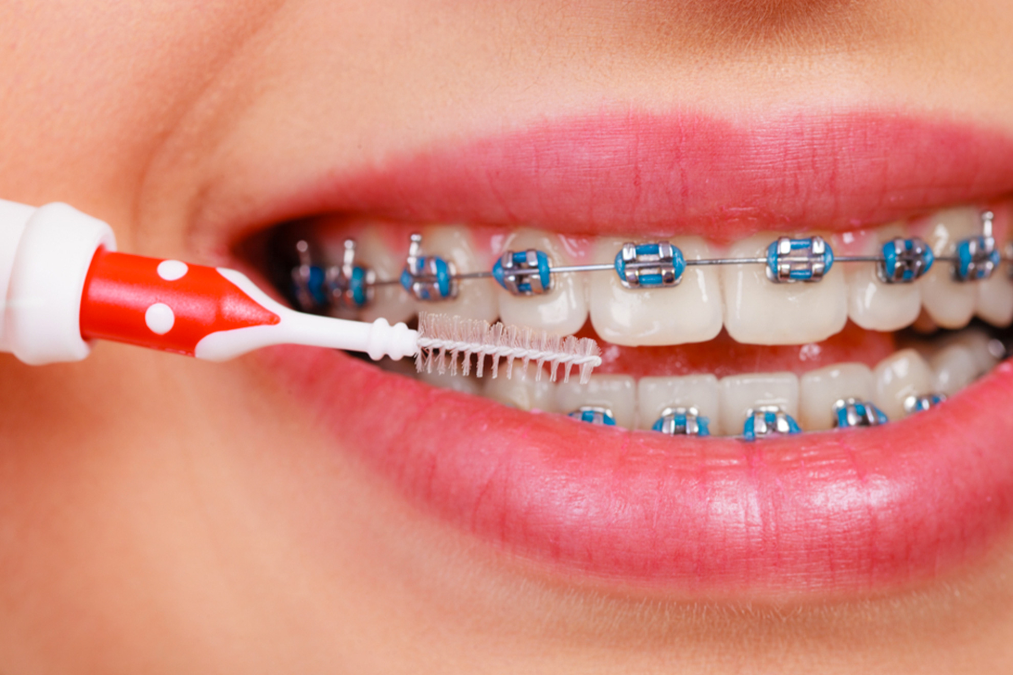 Come curare l'igiene orale con l'apparecchio