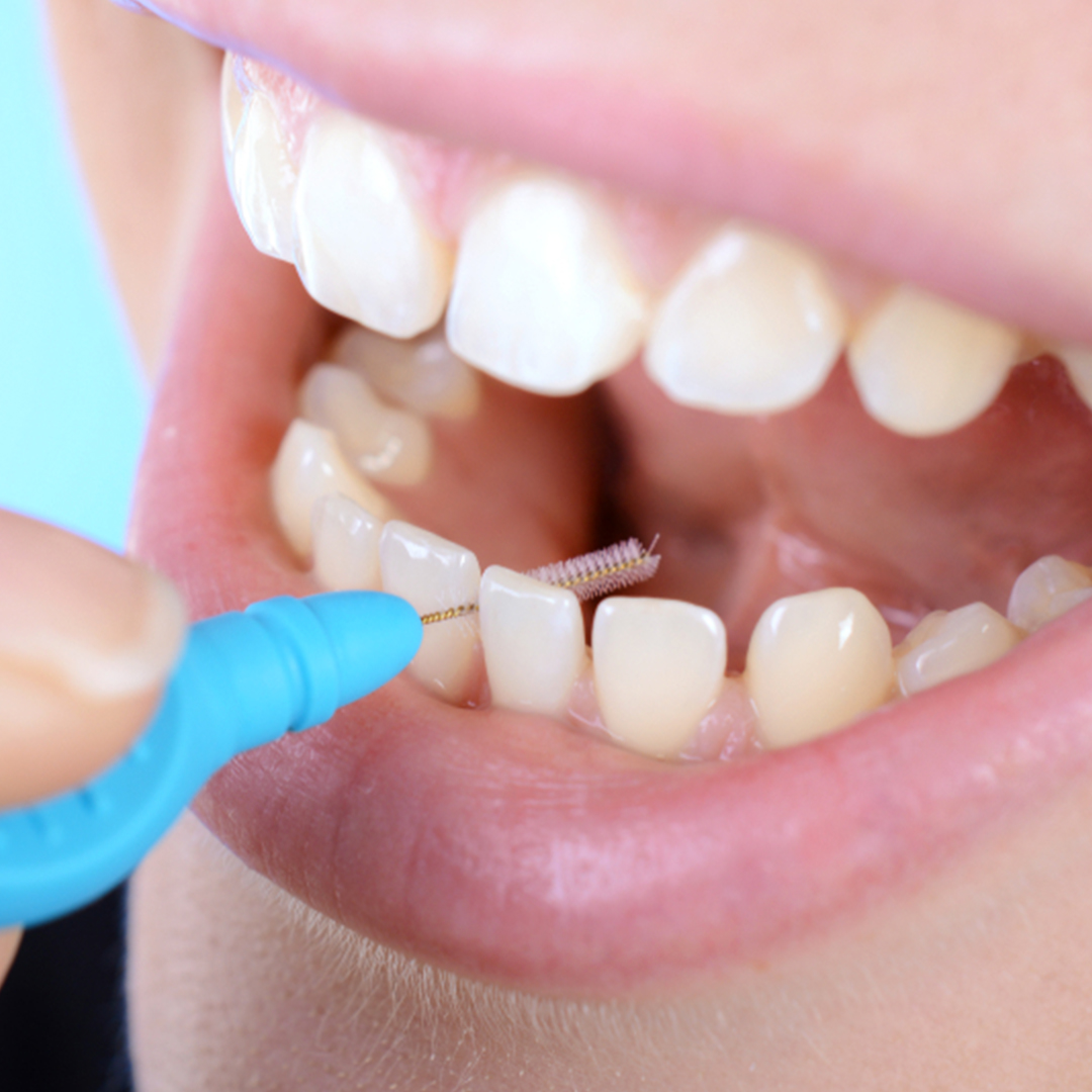 Sei sicuro di pulire bene gli spazi tra un dente e l'altro?